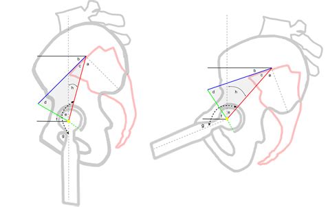 The Dorr Classification For Spinopelvic Functional Safe Component