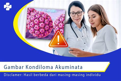 Gambar Kondiloma Akuminata Ini Panduan Visualnya Klinik Utama Sentosa