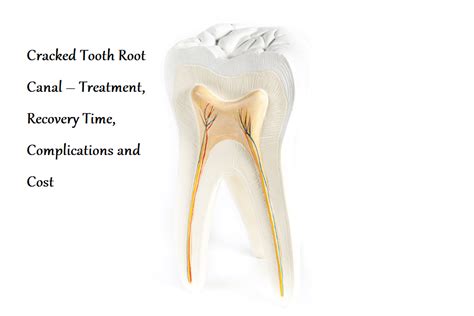 Cracked Tooth Root Canal Treatment Recovery Time Complications And Cost