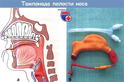 Основной способ остановки умеренного носового кровотечения тест с ответами