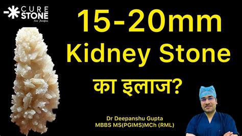 15 20mm Kidney Stone क इलज कस हत ह Treatment for 15 20 mm