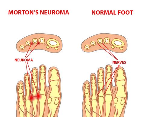 Morton’s Neuroma Symptoms and Treatment - Century Medical & Dental Center
