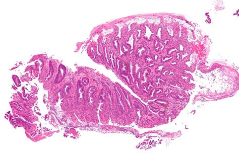 Ischemic Colitis