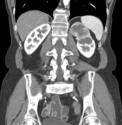 62-year-old female with gross hematuria - Auntminnie