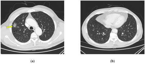 Healthcare Free Full Text Pneumocystis Pneumonia In A Non Immunocompromised Lung Cancer