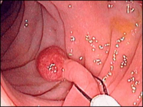 clérigo Proceso petróleo polipos en el colon Teoría de la relatividad