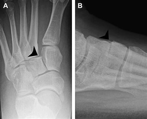 Mr Imaging Evaluation Of Subtle Lisfranc Injuries The Midfoot Sprain