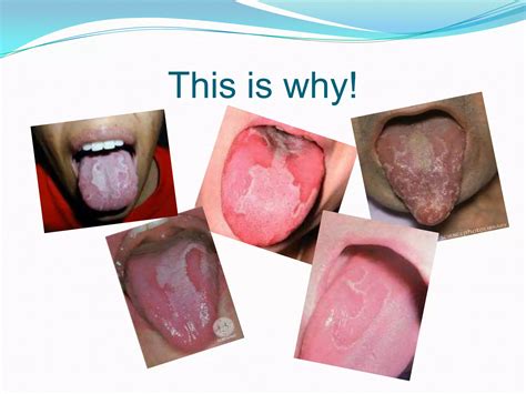 Geographic Tongue Disease Powerpoint Ppt