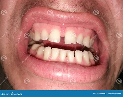 Curved Teeth In A Man S Mouth Stock Image Image Of Dental Teeth