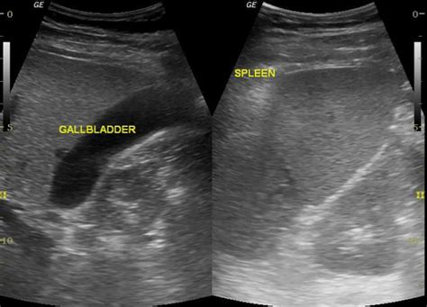 Superior Mesenteric Vein Ultrasound