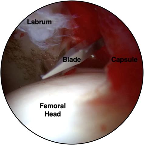 Basic Hip Arthroscopy Part 2 Central Compartment Arthroscopy