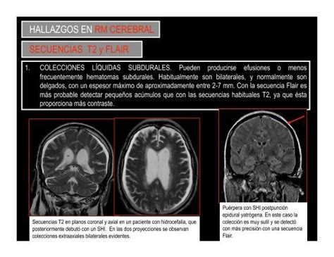 HALLAZGOS EN RM CEREBRAL SECUENCIAS T2 Y FLAIR