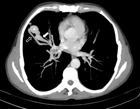 Pulmonary Arteriovenous Malformation In Hereditary Haemorrhagic