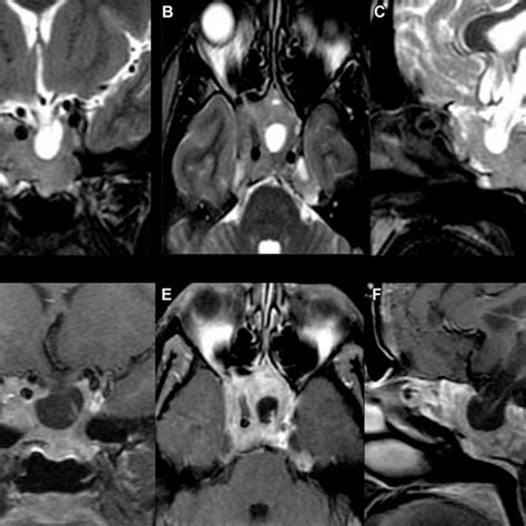 Lactotroph Pituitary Adenoma With Extensive Infarction And Hemorrhage