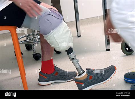 Vynnyky Ukraine May 1 2023 A Patient With A Prosthetic Leg