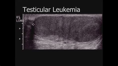 Pediatrics Scrotal Ultrasound Pediatrics Sonography Ultrasound