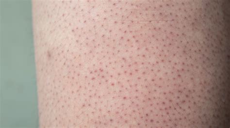 Understanding Keratosis Pilaris Causes Treatments And Effective Skincare Solutions Tareen