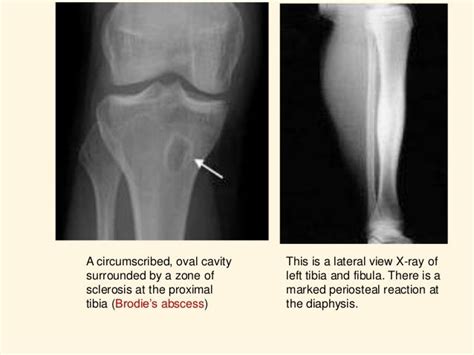 Osteomyelitis