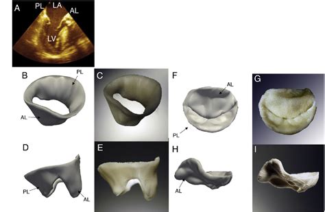 Figure From Three Dimensional Ultrasound Derived Physical Mitral