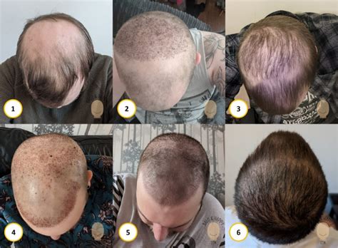 Is There A Phobia Of Bald People