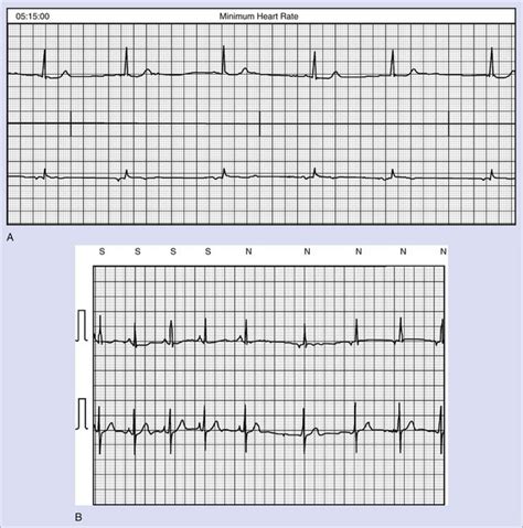 Sinus Node Dysfunction | Thoracic Key