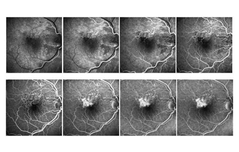 O Que Isso Da Angiografia Retina Centro Cir Rgico De Coimbra