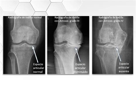 Procedimientos ortopédicos de rodilla Dr Daniel Romero Gamboa