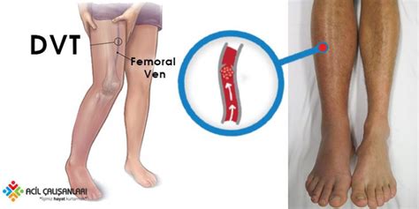 Derin Ven Trombozu DVT Acil Yaklaşım Acil Çalışanları