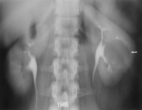 Intravenous Urography Technique And Interpretation Radiographics