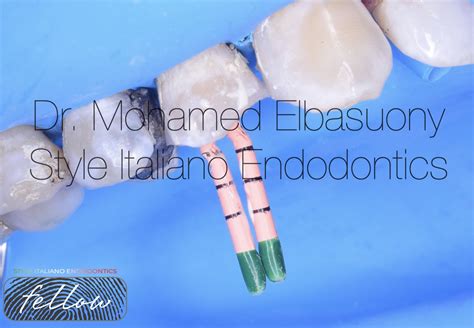 Orthodontic Extrusion For Proper Endodontic Therapy Style Italiano Endodontics