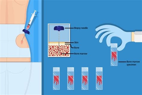 Bone Marrow Aspiration Jnu Hospital