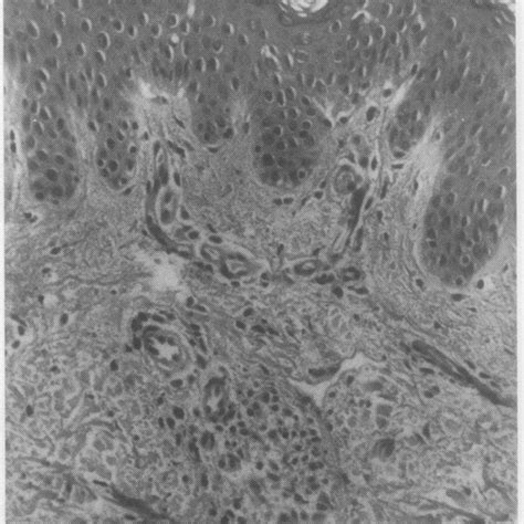 Photomicrograph Ofskin Biopsy Specimen Showing Perivascular Infiltrate