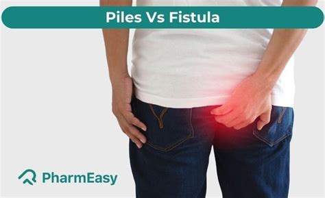 Difference Between Piles And Fistula Pharmeasy Blog