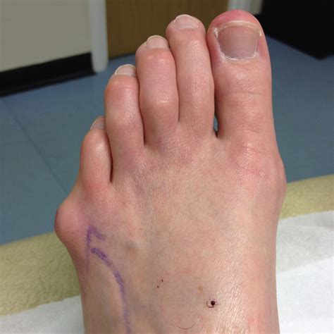 Bunion Surgery Leeds Yorkshire Foot Hospitalyorkshire Foot Hospital