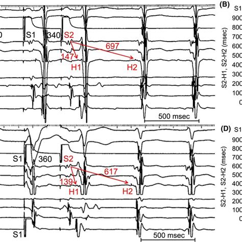 A Intracardiac Electrogram Shows Dvr By Atrial Premature Stimulation