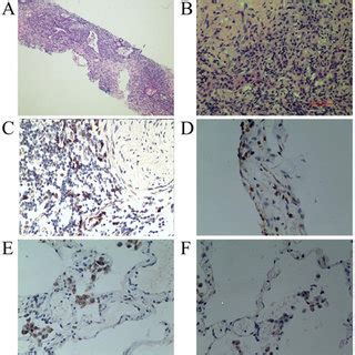 Histological Characteristics Of IgG4 Related Lung Disease In Case 1