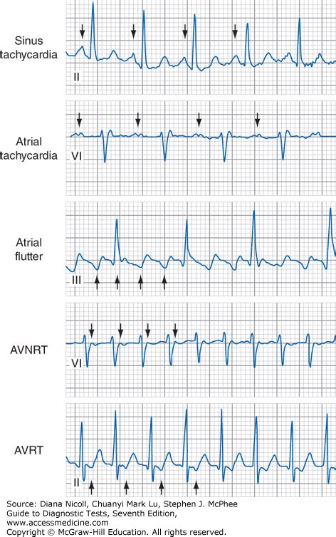 【印刷可能】 Sinus Tachycardia With Pvcs No St Segment Elevation 117587 Do Pvcs Cause Tachycardia