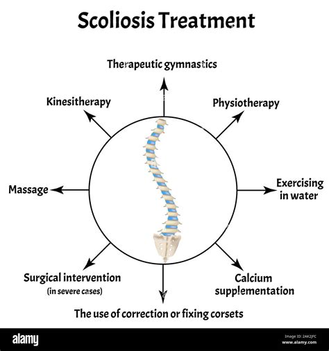 La Scoliosi Trattamento Curvatura Spinale Cifosi Lordosi Del Collo