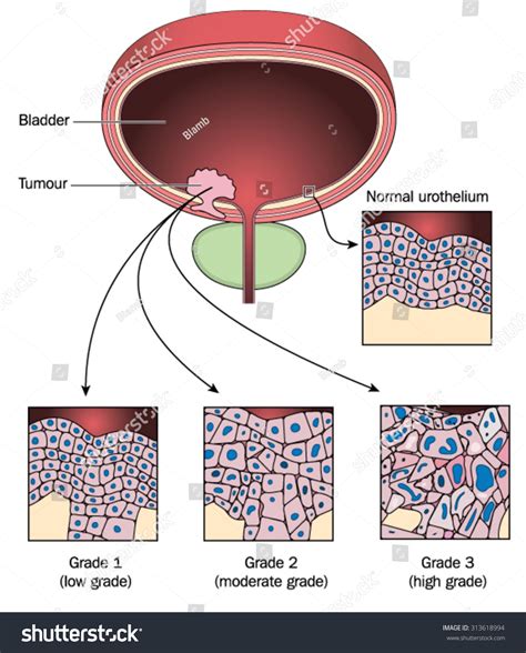 Tumour Bladder Wall Showing Normal Urothelial Stock Vector 313618994