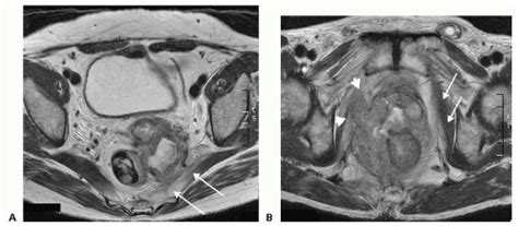 Pelvic Exenteration Basicmedical Key