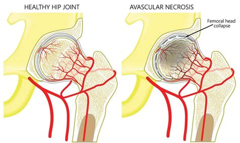 Hip Osteonecrosis Private Treatment In Gloucestershire