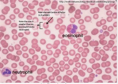 Path Anemia Normocytic Anemia Flashcards Quizlet