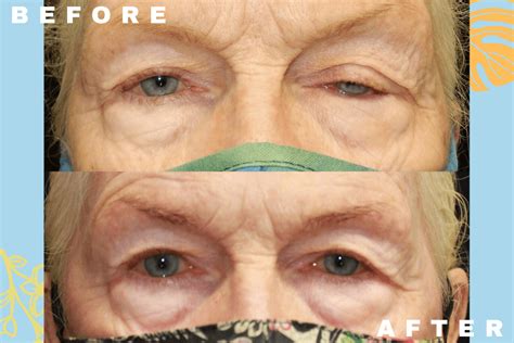 Ptosis Repair Honolulu Eyelid Surgery Oahu The Oculoplastics Center