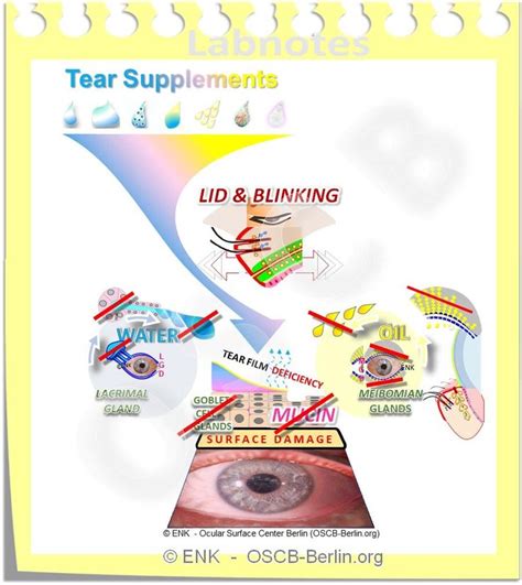 Tear Supplements Overview If When Why What Ocular