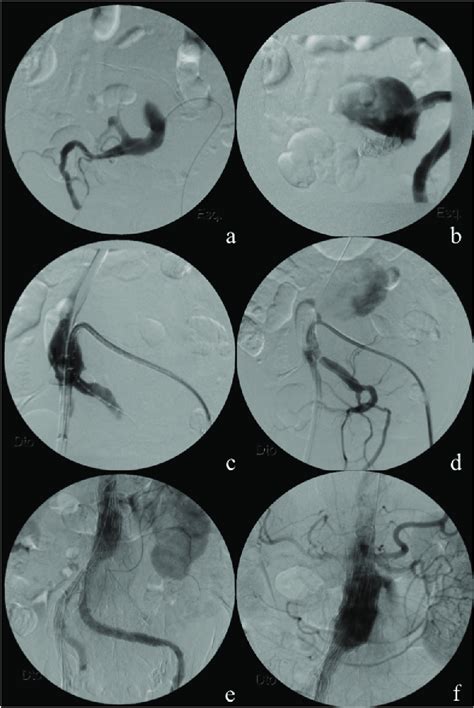 A And B Left Internal Iliac Artery Embolization C And D Iliac