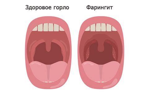 Как Выглядит Здоровое Горло Фото – Telegraph