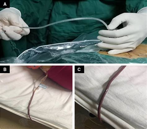 Postoperative drainage of pus. | Download Scientific Diagram