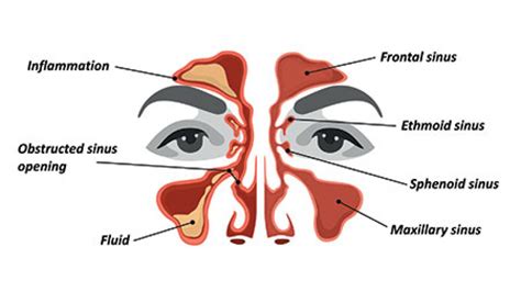 Can A Sinus Infection Make You Feel Lightheaded | Americanwarmoms.org