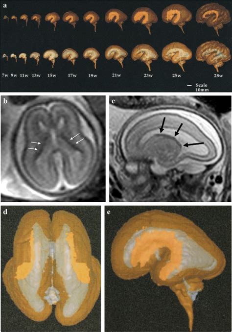 Development Of The Germinal Matrix A Sequential Images Show Concurrent