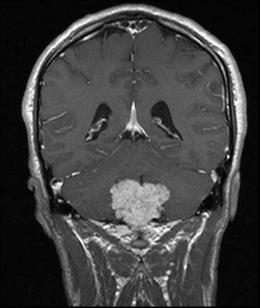 Choroid Plexus Papilloma Image Radiopaedia Org